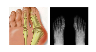 Minimal-invasive Fußchirurgie / Hallux valgus