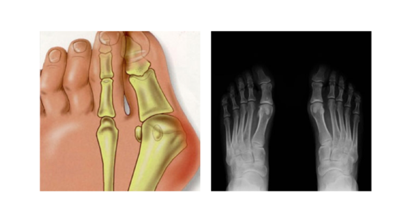 Minimal-invasive Fußchirurgie / Hallux valgus - Dr. Hermann Leidolf - Unfallchirurg Wien 1010