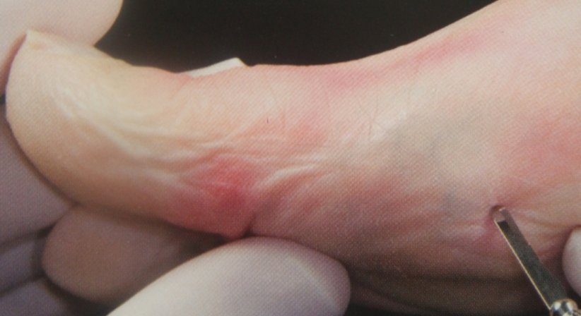 Minimal-invasive Fußchirurgie / Hallux valgus - Dr. Hermann Leidolf - Unfallchirurg Wien 1010