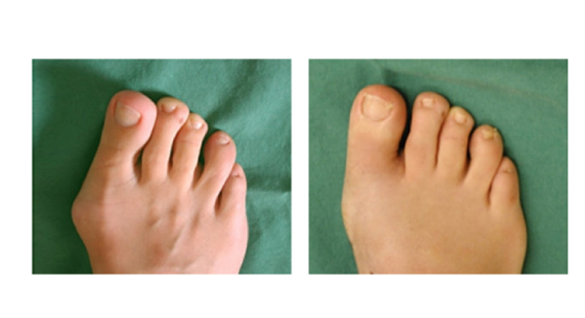 Minimal-invasive Fußchirurgie / Hallux valgus - Dr. Hermann Leidolf - Unfallchirurg Wien 1010