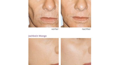 Faltenbehandlung - Botox, Hyaluronsäure