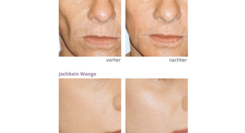 Faltenbehandlung - Botox, Hyaluronsäure - Dr. Karin Girkinger - Praktische Ärztin Wien 1070