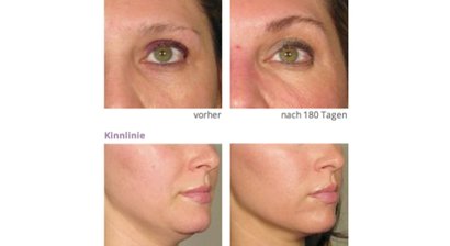 Hautverjüngung mit Ultherapy