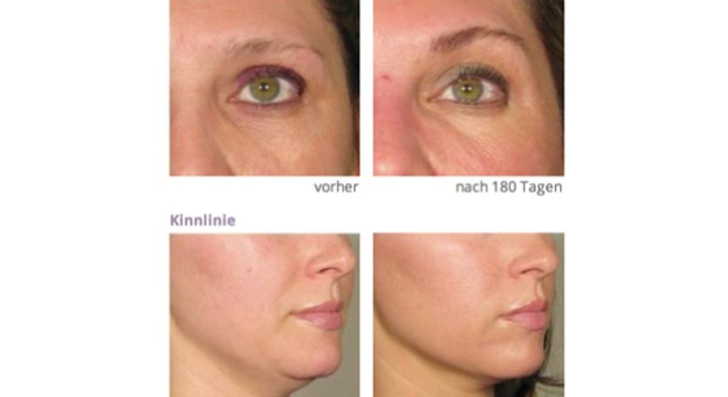 Hautverjüngung mit Ultherapy - Dr. Karin Girkinger - Praktische Ärztin Wien 1070