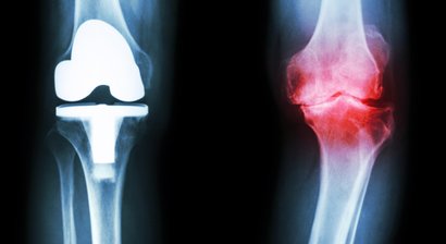 Kniebeschwerden/Knieprothese