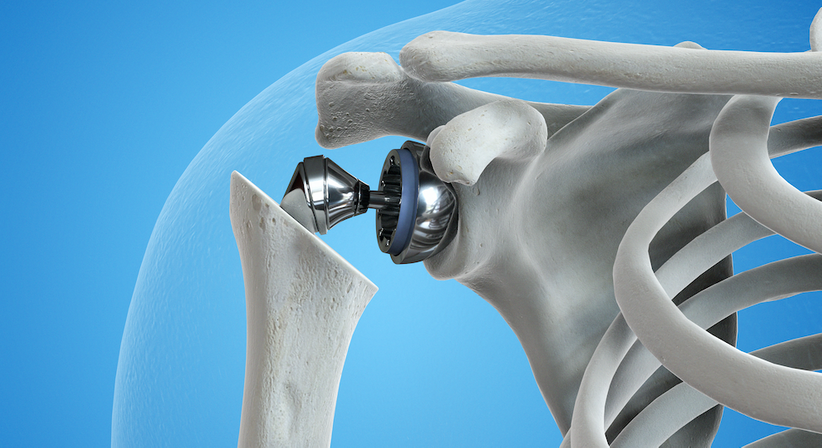 Schulterprothese - OA Dr. Philip Zeller - Orthopäde Baden 2500