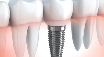 Implantologie/Navigierte Implantologie