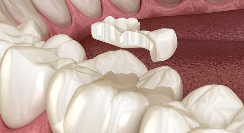 Inlays / Onlays - Dr. med. dent. Agnes Mészáros - Zahnärztin Wien 1010