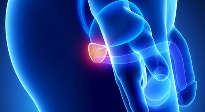 Prostataerkrankungen