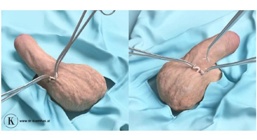 Vasektomie - Dr. Franklin Emmanuel Kühhas - Urologe Wien 1080