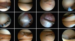 Knorpelaufbau (konservative Behandlung bei Arthrose) -