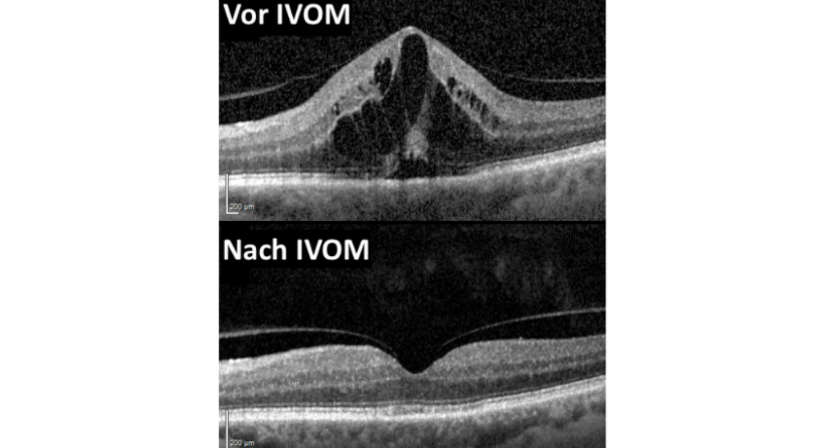 IVOM (Intravitreale Medikamenteneingabe) - Prof. Dr. Martin Dirisamer, FEBO - Augenarzt Linz 4020