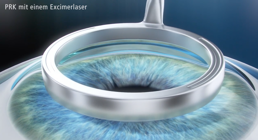 PRK (LASEK) - Prof. Dr. Martin Dirisamer, FEBO - Augenarzt Linz 4020