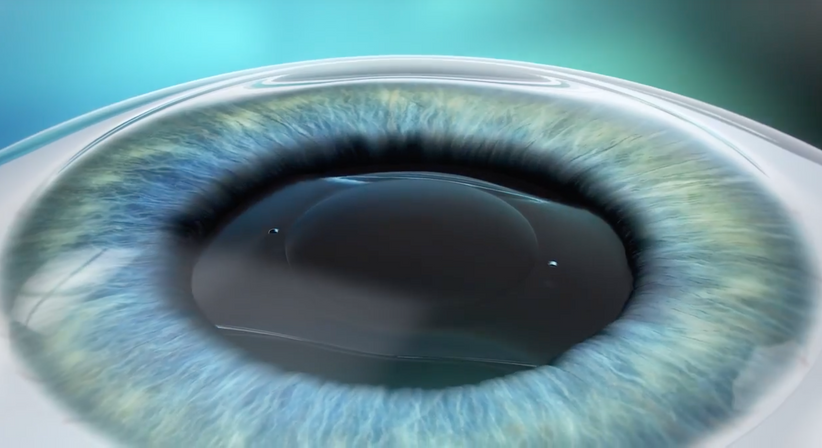 ICL – Implantierbare Collamer Linse - Prof. Dr. Martin Dirisamer, FEBO - Augenarzt Linz 4020