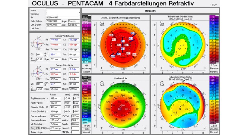 Hornhaut-Erkrankungen - Prof. Dr. Martin Dirisamer, FEBO - Augenarzt Linz 4020