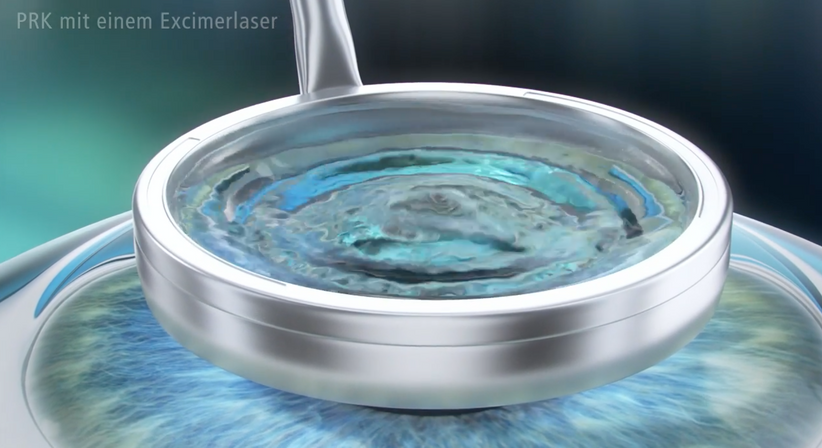 PRK (LASEK) - Prof. Dr. Martin Dirisamer, FEBO - Augenarzt Linz 4020