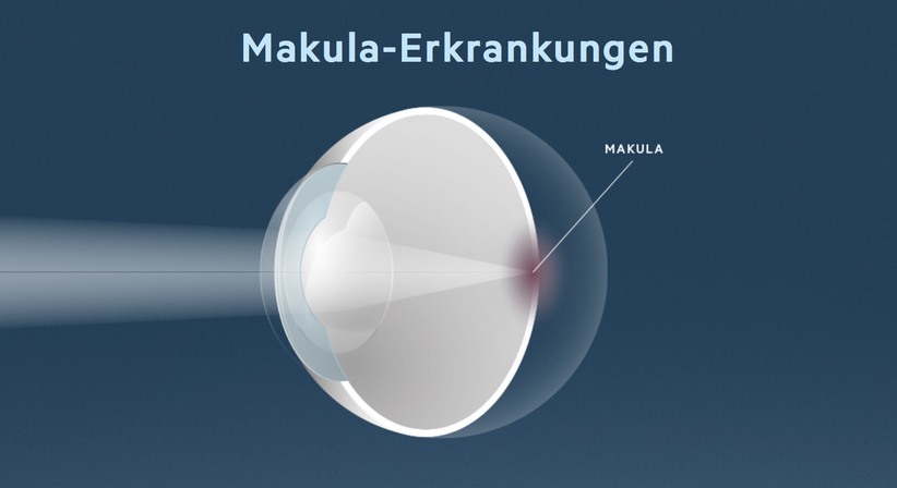 Makula-Erkrankungen - Prof. Dr. Martin Dirisamer, FEBO - Augenarzt Linz 4020