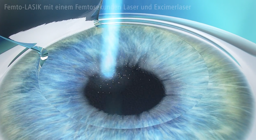 Femtosekunden-LASIK - Prof. Dr. Martin Dirisamer, FEBO - Augenarzt Linz 4020