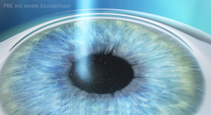 PRK (LASEK) - Prof. Dr. Martin Dirisamer, FEBO - Augenarzt Linz 4020