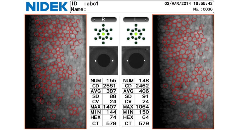 Hornhaut-Erkrankungen - Prof. Dr. Martin Dirisamer, FEBO - Augenarzt Linz 4020