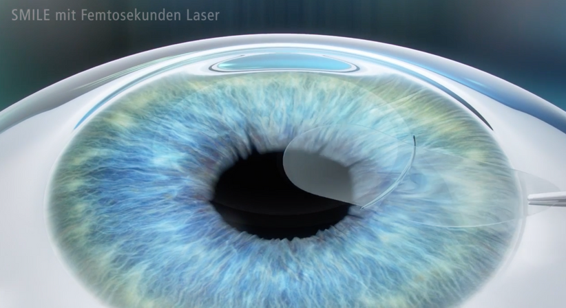 Relex SMILE - Prof. Dr. Martin Dirisamer, FEBO - Augenarzt Linz 4020