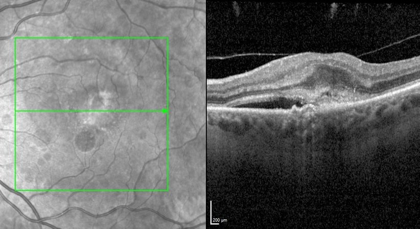 Makula-Erkrankungen - Prof. Dr. Martin Dirisamer, FEBO - Augenarzt Linz 4020