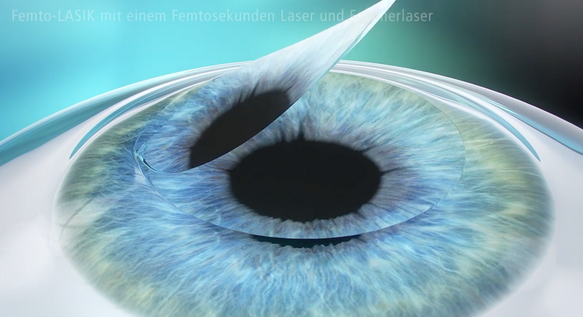 Femtosekunden-LASIK - Prof. Dr. Martin Dirisamer, FEBO - Augenarzt Linz 4020