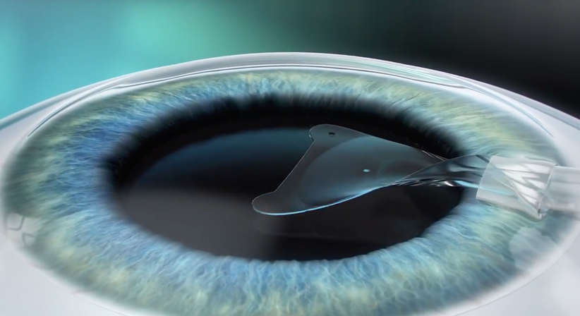 ICL – Implantierbare Collamer Linse - Prof. Dr. Martin Dirisamer, FEBO - Augenarzt Linz 4020