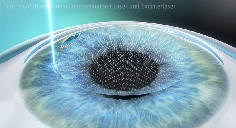 Femtosekunden-LASIK - Prof. Dr. Martin Dirisamer, FEBO - Augenarzt Linz 4020