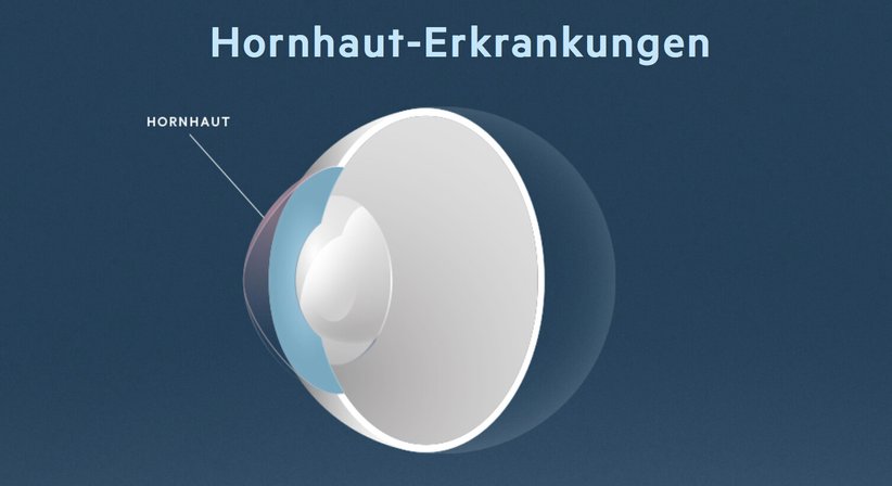 Hornhaut-Erkrankungen - Prof. Dr. Martin Dirisamer, FEBO - Augenarzt Linz 4020