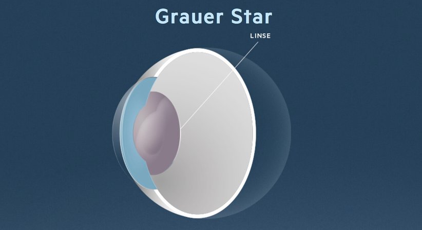 Grauer Star (Katarakt) - Prof. Dr. Martin Dirisamer, FEBO - Augenarzt Linz 4020