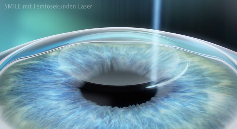 Relex SMILE - Prof. Dr. Martin Dirisamer, FEBO - Augenarzt Linz 4020