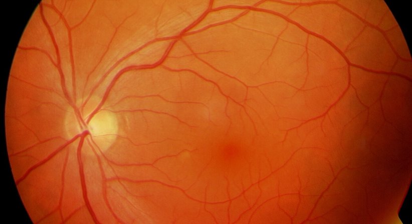 Makula-Erkrankungen - Prof. Dr. Martin Dirisamer, FEBO - Augenarzt Linz 4020