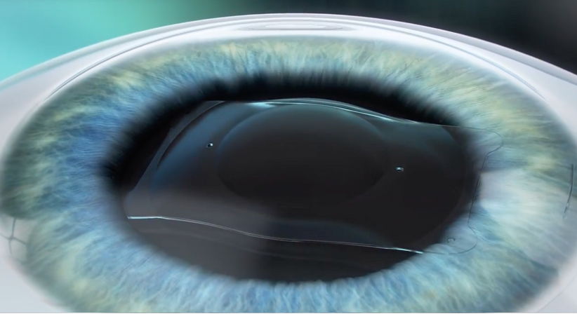 ICL – Implantierbare Collamer Linse - Prof. Dr. Martin Dirisamer, FEBO - Augenarzt Linz 4020