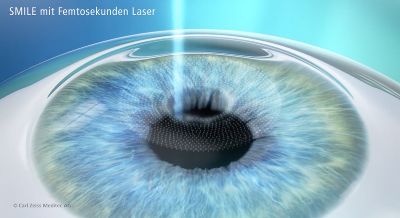 Relex SMILE - Prof. Dr. Martin Dirisamer, FEBO - Augenarzt Linz 4020