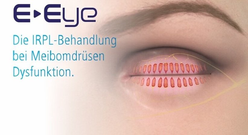 Trockenes Auge - Prof. Dr. Martin Dirisamer, FEBO - Augenarzt Linz 4020