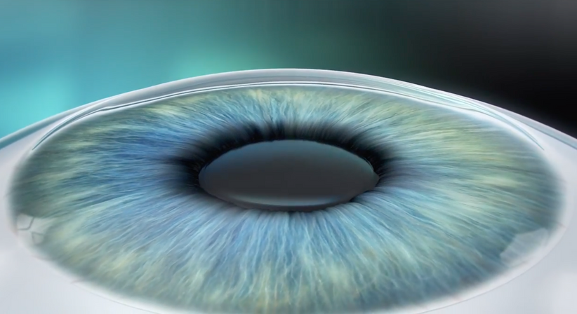 ICL – Implantierbare Collamer Linse - Prof. Dr. Martin Dirisamer, FEBO - Augenarzt Linz 4020