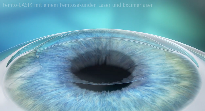 Femtosekunden-LASIK - Prof. Dr. Martin Dirisamer, FEBO - Augenarzt Linz 4020