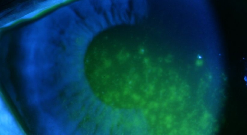 Trockenes Auge - Prof. Dr. Martin Dirisamer, FEBO - Augenarzt Linz 4020