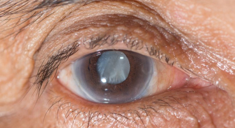 Grauer Star (Katarakt) - Prof. Dr. Martin Dirisamer, FEBO - Augenarzt Linz 4020