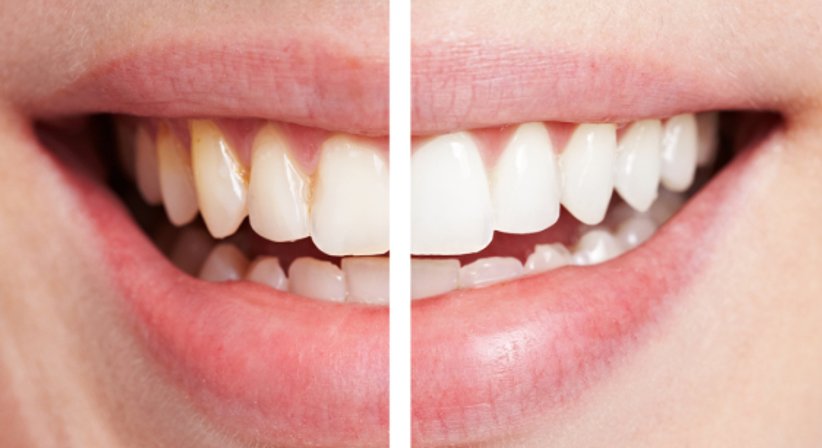 Bleaching & professionelle Mundhygiene - Dr. Bernhard Witzmann - Zahnarzt Wien 1190