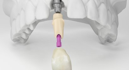 Implantate & Implantatprothetik