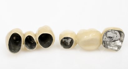 Verblend-Metall-Keramische Kronen & Brücken ( VMK )