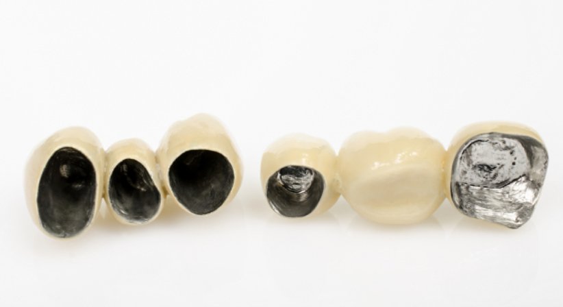 Verblend-Metall-Keramische Kronen & Brücken ( VMK ) - Dr. Bernhard Witzmann - Zahnarzt Wien 1190