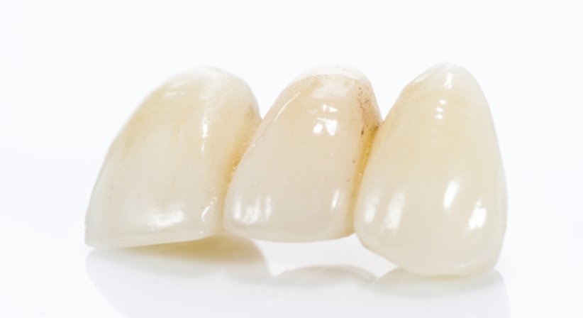 Vollkeramische Kronen & Brücken - Dr. Bernhard Witzmann - Zahnarzt Wien 1190