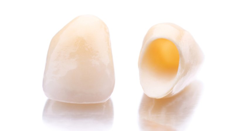 Vollkeramische Kronen & Brücken - Dr. Bernhard Witzmann - Zahnarzt Wien 1190