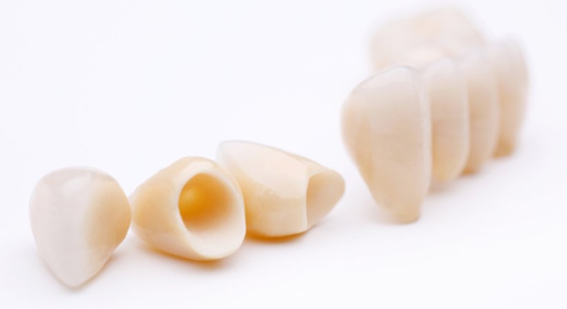 Zirkon Kronen & Brücken - Dr. Bernhard Witzmann - Zahnarzt Wien 1190