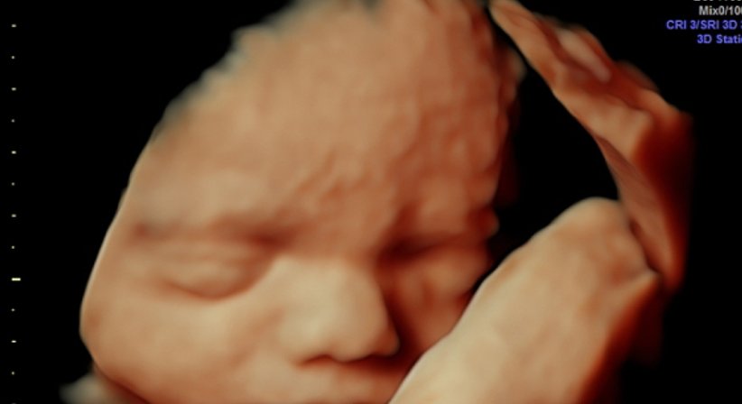 3D/4D Ultraschall - Dr. med. Gerald Bräutigam - Frauenarzt Linz 4020