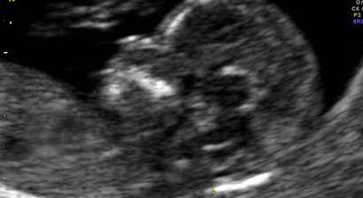 Nackentransparenzmessung 12.-14. SSW inkl. NIPT/NIFTY Test