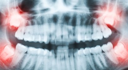 Chirurgische Weisheitszahnentfernug und Wurzelspitzenresektionen 